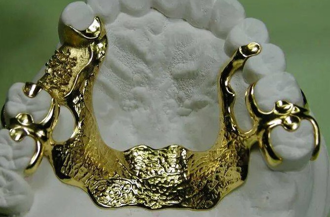 Are Gold Dentures a Thing of the Past? Exploring Their History and Legacy in Dentistry